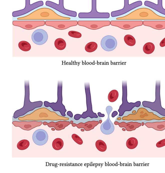A healthy blood-brain barrier (top) and a drug-resistant epilepsy blood-brain barrier (bottom). Illustration by MJ Soares